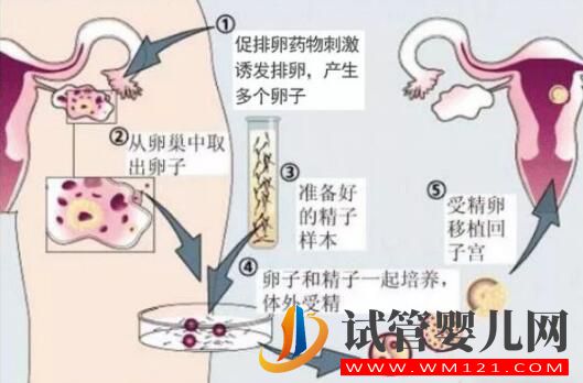 人工授精多次失败后还可以做试管婴儿吗?