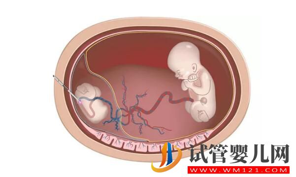 试管婴儿减胎术在哪些情况下使用 要注意哪些