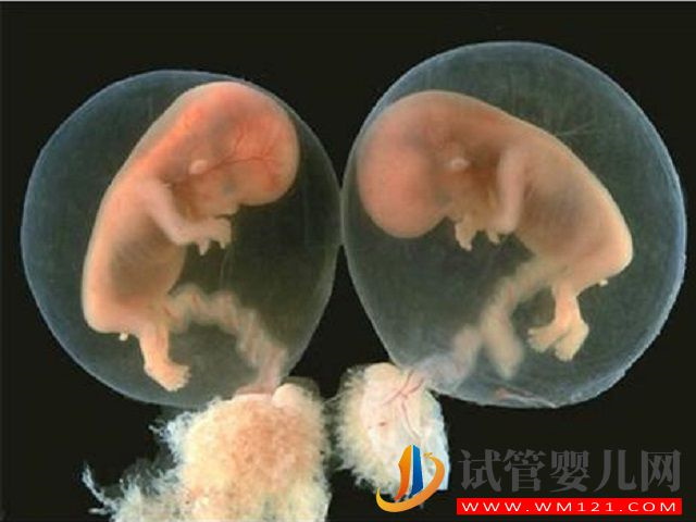 有遗传因素的女性更容易怀单卵双胎