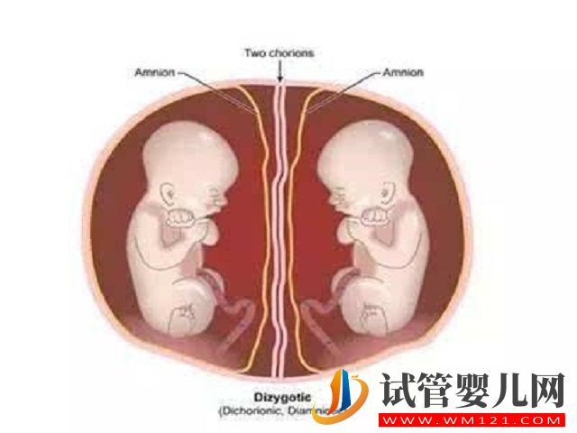 单胎变双胎有四种类型