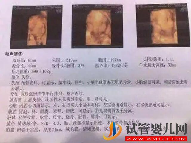 B超单上一个孕囊双胞胎就是只有一个孕囊两个胎心