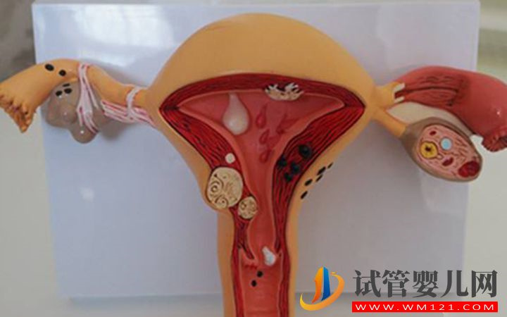 子宫内膜异位症是引起排卵障碍的原因之一