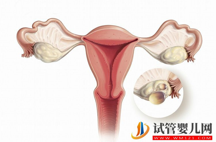 促排卵可能会诱发卵巢过度刺激综合征