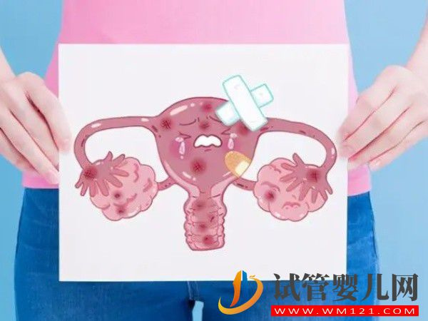 子宫内膜异位会引起盆腔粘连