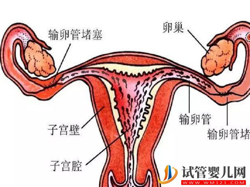 输卵管堵塞展示图