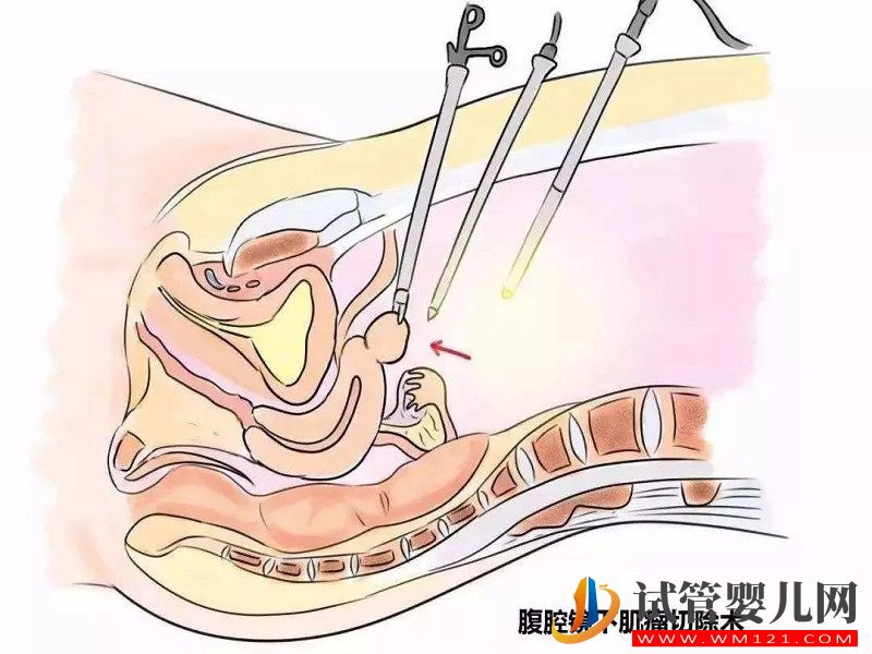 子宫肌瘤可以通过手术治疗