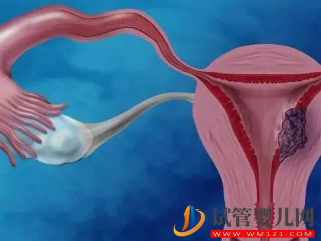 子宫内膜问题会导致试管移植失败