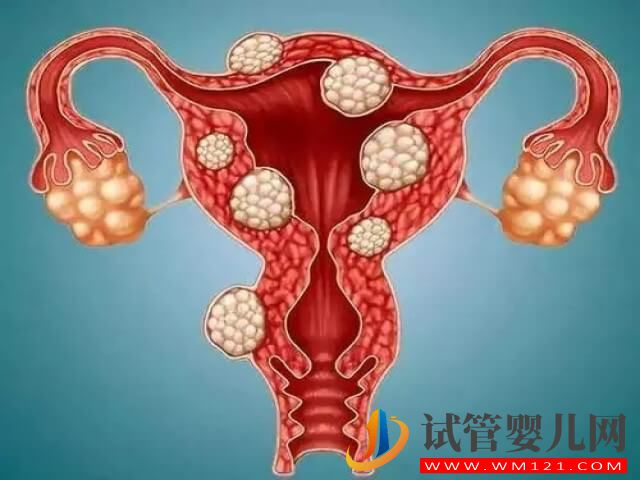 多囊试管取卵后空卵泡数量卵巢功能有关