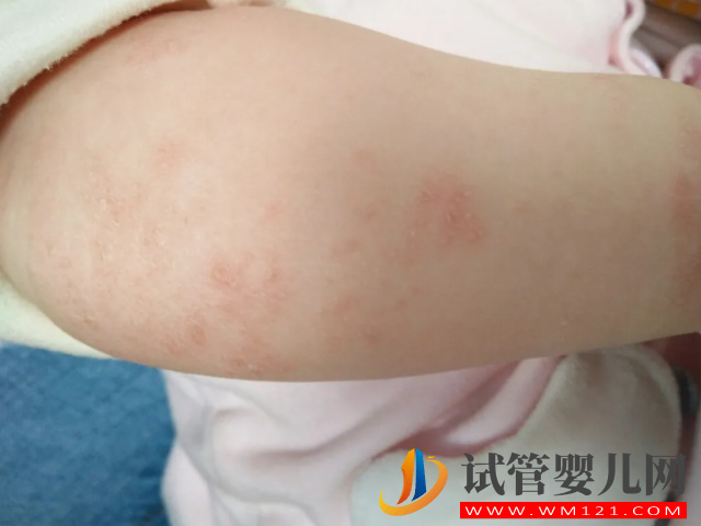 泛发性湿疹可以发生于全身任一部位