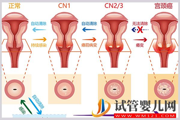 女性宫颈病变无病毒感染可以做试管