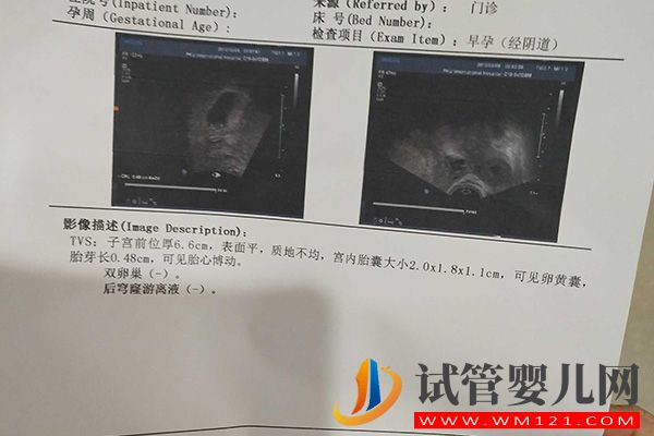 大部分女性移植28天宝宝有胎芽