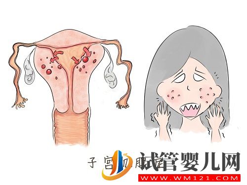 子宫内膜异位症——痛经的一种常见病因(图8)