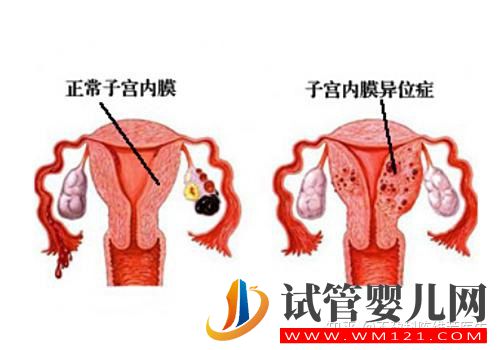子宫内膜异位症有这4种类型,难怪症状不一样(图1)