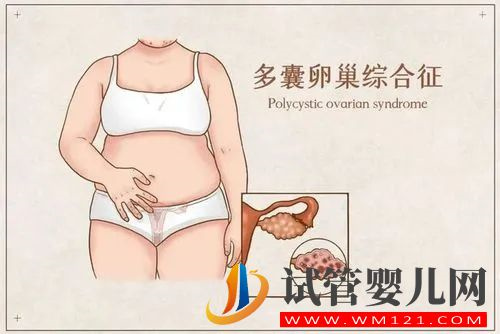 多囊卵巢初期都有什么症状(图1)