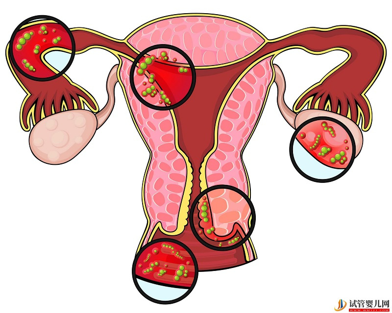 盆腔积液会影响怀孕吗？盆腔积液对怀孕有什么影响？(图1)