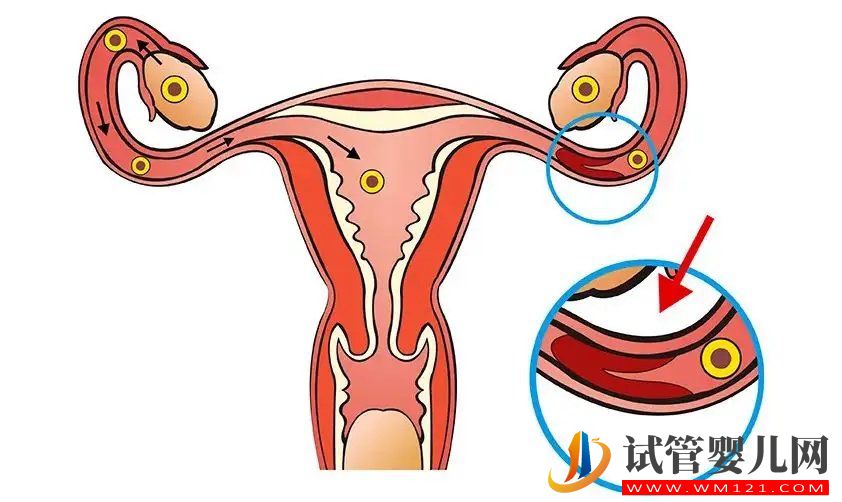 做好预防输卵管堵塞的工作(图1)