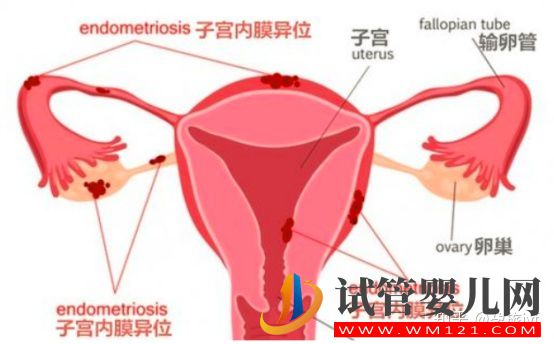 子宫内膜异位症是什么(图1)