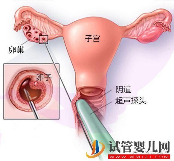 卵子是怎么取出来的_揭秘取卵过程(图1)