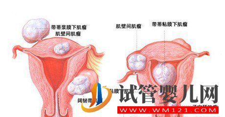 输卵管通液和输卵管造影有什么区别