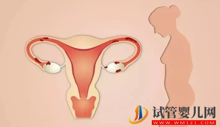 如果输卵管出现堵塞自然受孕困难是不是做试管婴儿才能怀孕呢？