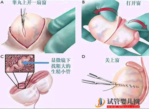 显微取精操作步骤图